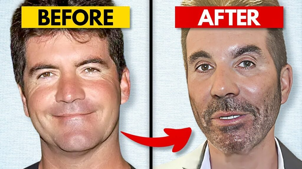Simon Cowell plastic surgery