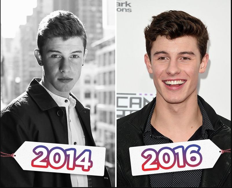 Shawn Mendes Plastic Surgery