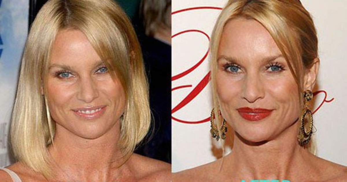 Nicollette Sheridan Plastic Surgery