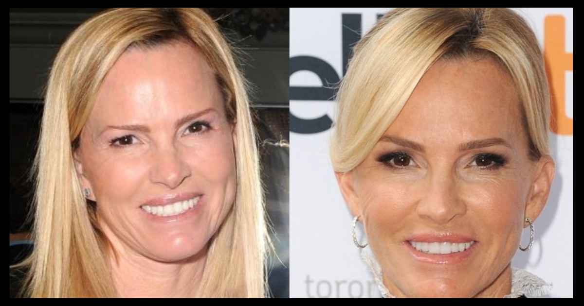Janet Jones Plastic Surgery